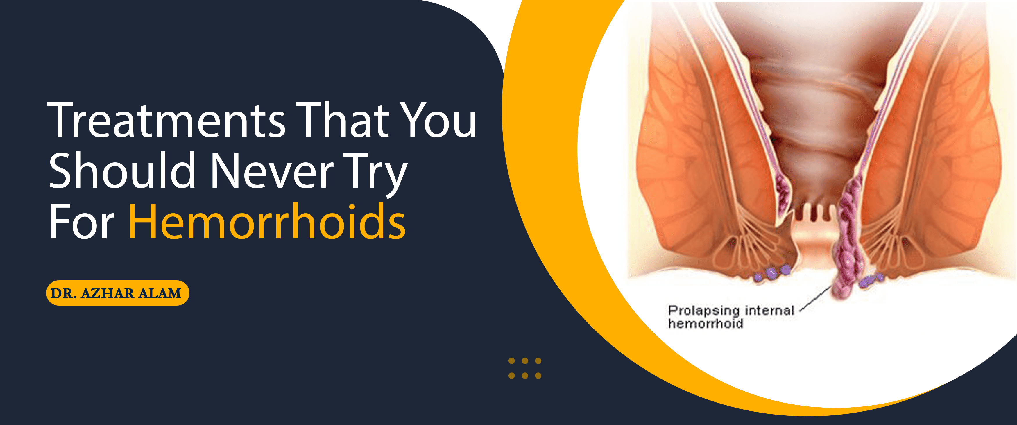Hemorrhoids Treatments